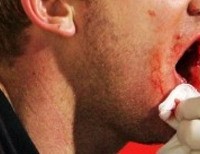 Το ηλεκτρονικό τσιγάρο εξερράγη στο στόμα του, ενώ κάπνιζε!