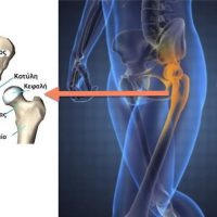 Κατάγματα ισχίου σε ηλικιωμένους: Ενυπάρχοντα προβλήματα και επιπλοκές