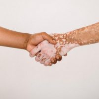 Ψωρίαση: Οι επιπτώσεις στην ψυχολογία και τρόποι αντιμετώπισης