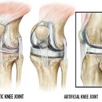 2 + 1 συχνές απορίες για ορθοπεδικά προβλήματα