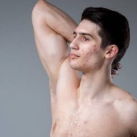 Ακμή: Πως την αντιμετωπίζουν οι δερματολόγοι