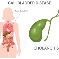 Πέτρα στη χολή: Όλα όσα πρέπει να γνωρίζετε